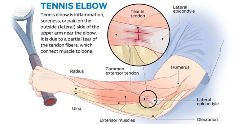 How-To-Get-Rid-Of-Tennis-Elbow-f
